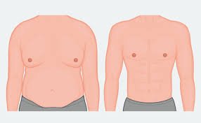 MALE BREAST SURGERY (GYNACOMASTIA)